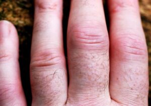 Rheumatoid Arthritis Chronic Inflammation Image source Flickr SaferCures.com